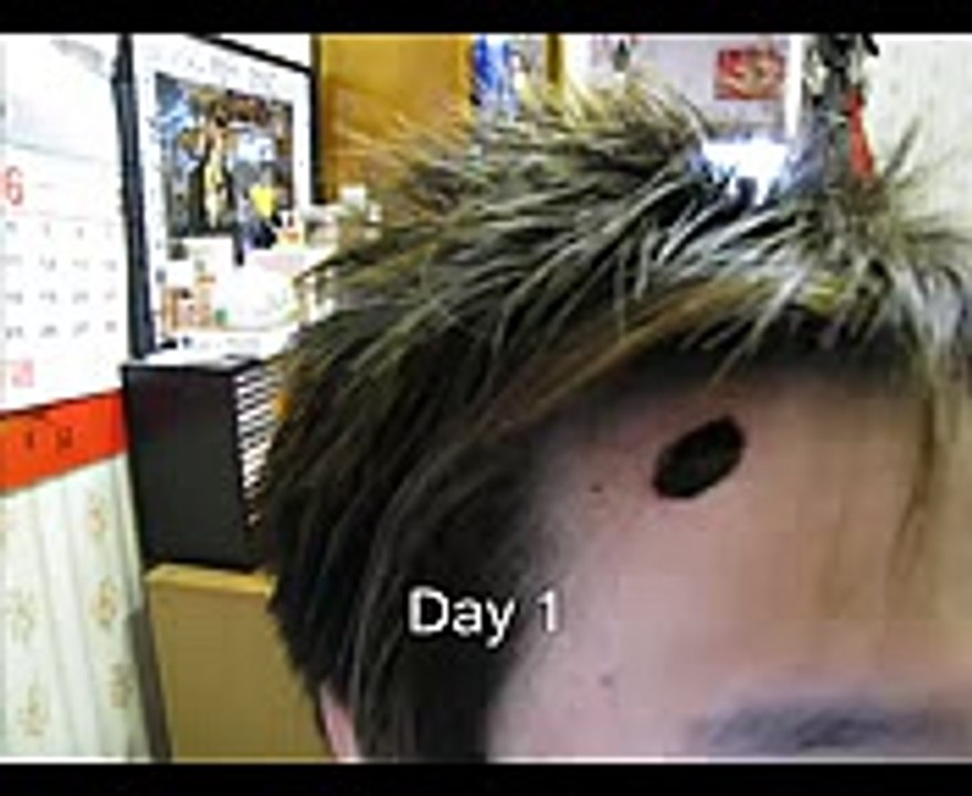 Big Big Mole Removal