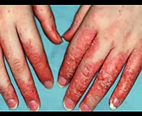 Eczema Treatment - The Benefits of Treating Eczema with Home Remedies