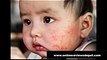 how to cure eczema in babies naturally  - treat baby  eczema naturally at home