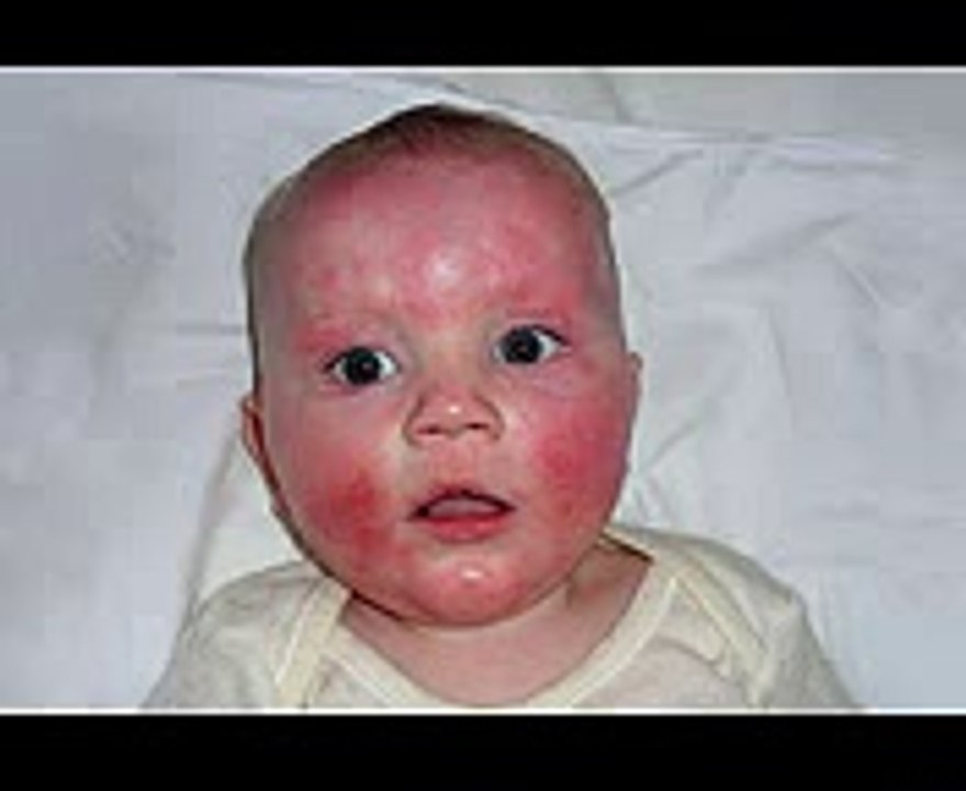 How to Cure Eczema in Babies Naturally 5 Tips On How To Eczema Home ...