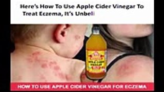 How To Use Apple Cider Vinegar To Treat Eczema, It’s Unbelievably Effective
