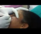 MOLE REMOVAL  TREATMENT, Dr. KULDEEP SINGH SKIN CLINIC, AHMEDABAD GUJARAT