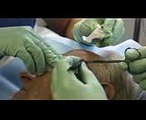 Skin Cancer Surgery - Basal Cell Carcinoma Excision