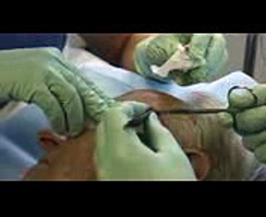Skin Cancer Surgery - Basal Cell Carcinoma Excision