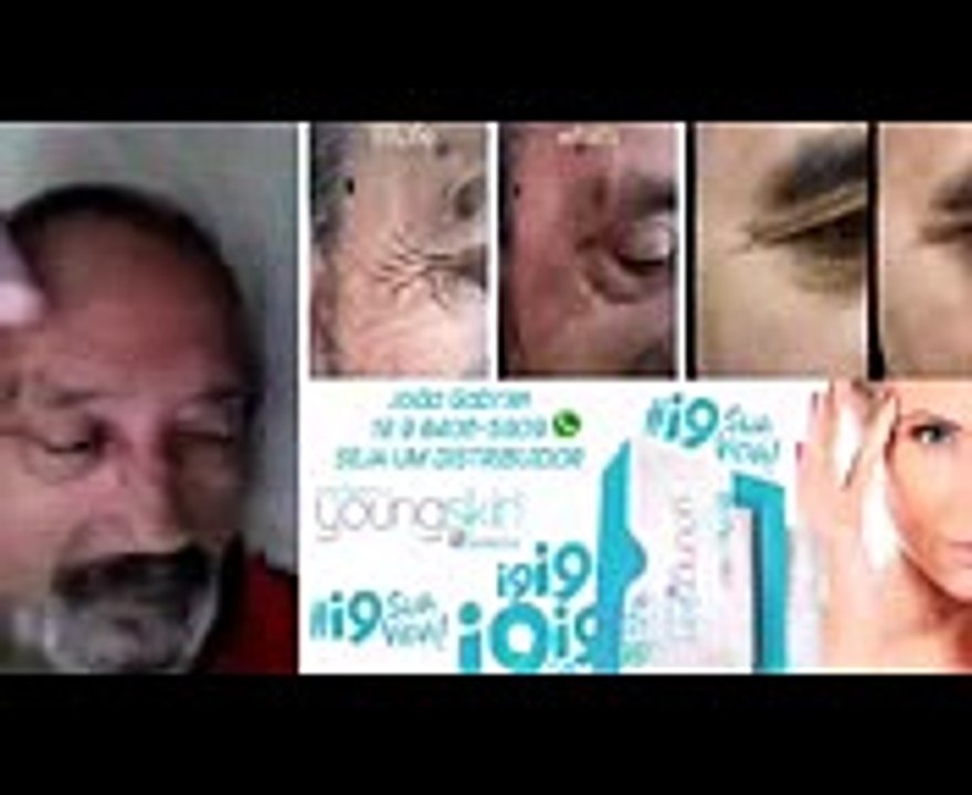 botox sem agulhas young skin i9life