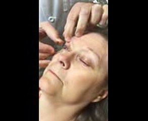 Sjogrens Syndrome  Keratoconjunctivitis Case Study