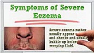 Severe Eczema - Severe Eczema Treatment - Severe Eczema Remedies - Severe Eczema Pictures
