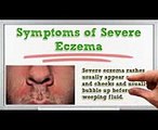Severe Eczema - Severe Eczema Treatment - Severe Eczema Remedies - Severe Eczema Pictures