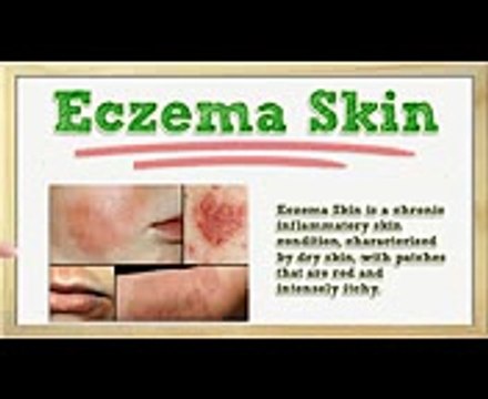 Eczema Skin - Eczema Skin Treatment - Eczema Skin Problem - Skin Eczema Disease Pictures