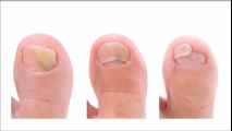 Nail fungus care & Treatment By Heel Pain Institute Of America