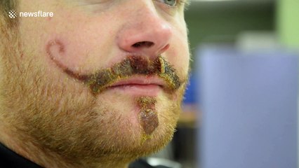 Holidaymaker potentially scarred for life - by a henna tattoo MOUSTACHE.