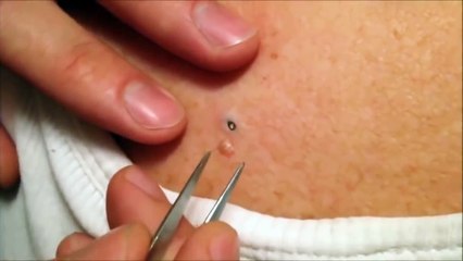 거대한 블랙 헤드 & 화이트 헤드 편집 지구의 여드름 | Blackhead 10