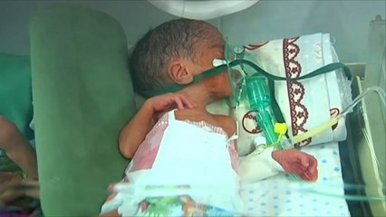 أطفال الحرب في اليمن.. جوع ومرض وأحزان من المهد