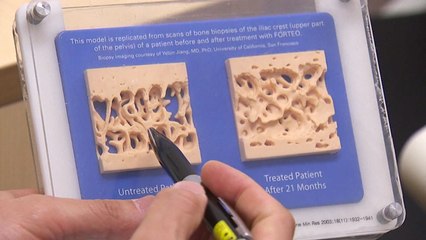 조용한 도둑 '골다공증'...60·70대 여성 노린다 / YTN