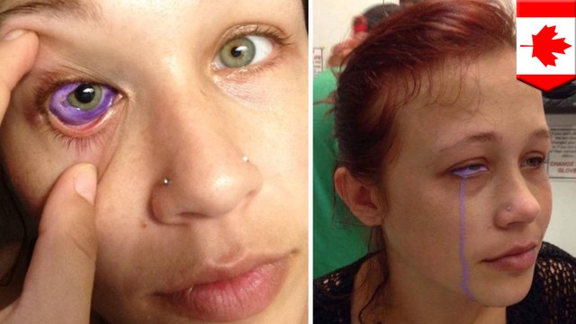 Canadian model might get eye removed after botched tattoo job