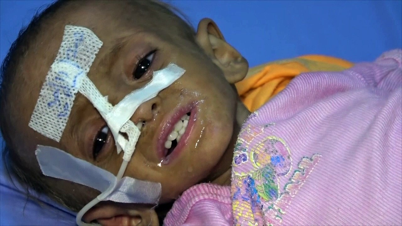 Famine and disease spread in Yemen's civil war
