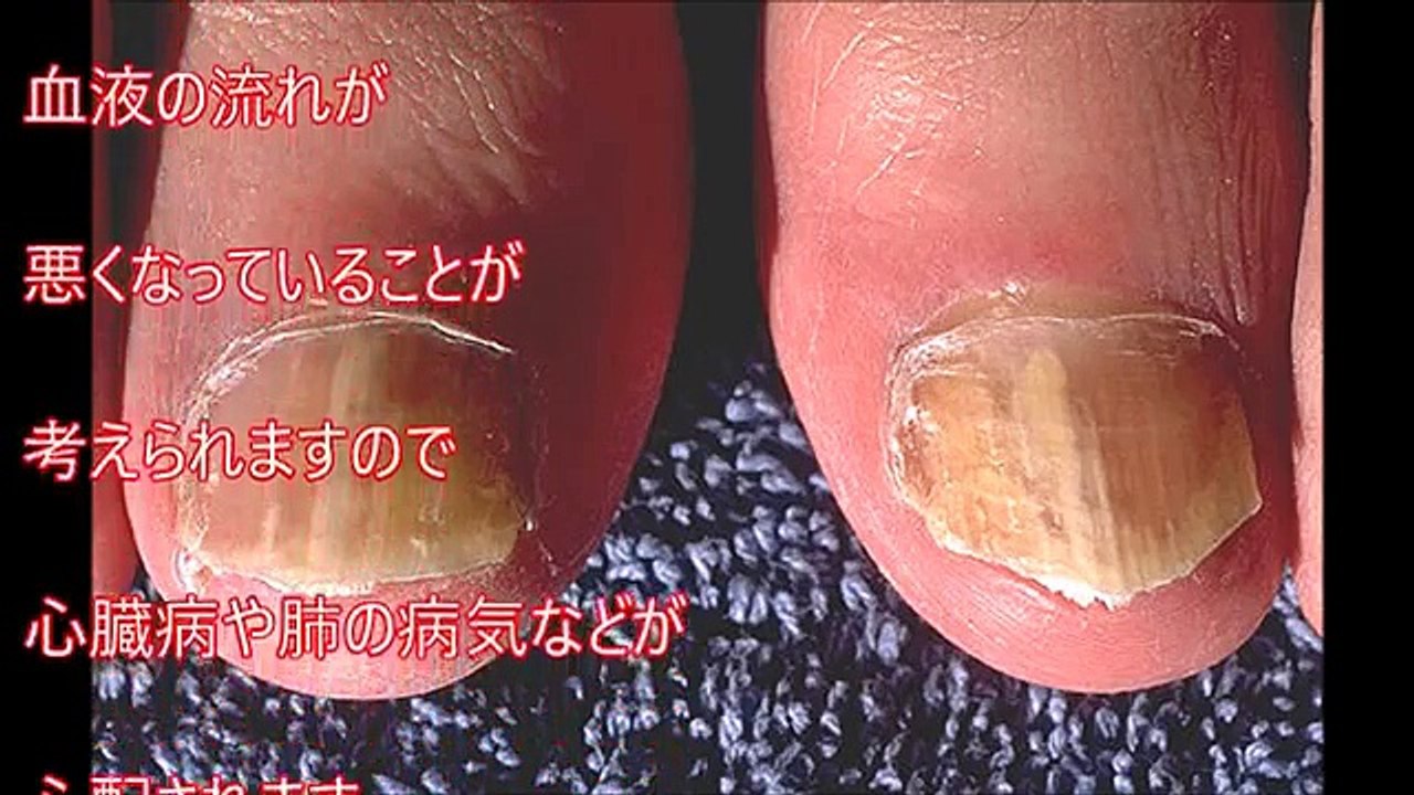 【雑学】爪に縦の線があると○○！ 爪を見るだけで健康状態が分かる！この12の症状は病気のサインかも？【衝撃】