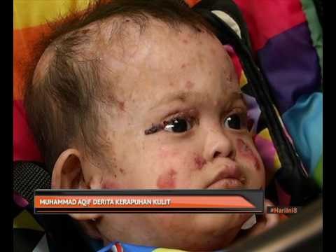 Muhammad Aqif derita kerapuhan kulit