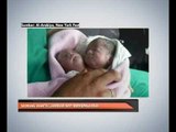 Seorang wanita lahirkan bayi berkepala dua