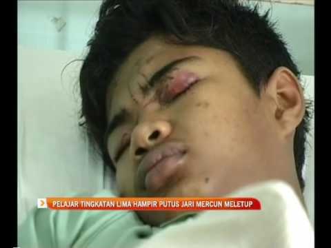 Pelajar tingkatan lima hampir putus jari mercun meletup