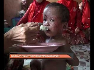 Derita bayi penyakit kulit kronik perlukan bantuan