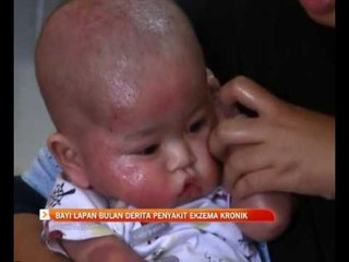 Bayi 8 bulan derita penyakit ekzema kronik