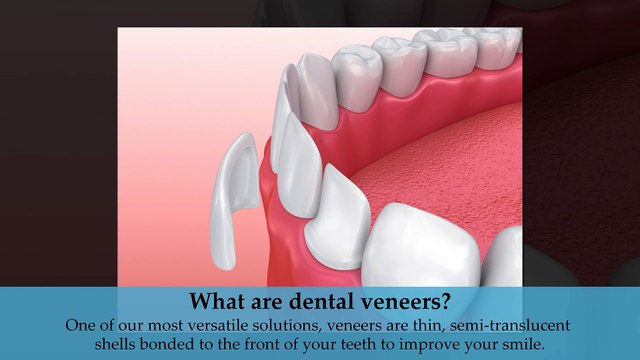 Dental Veneers in Elk Grove Village, IL - Brian Homann, DDS