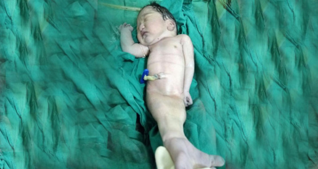 Sebebi Çok Acı! Deniz Kızı Gibi Doğdu, Doğumdan Dört Saat Sonra Hayatını Kaybetti