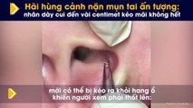 Hãi hùng cảnh nặn mụn tai ấn tượng: nhân dày cui đến vài centimet kéo mãi không hết