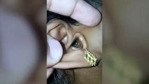 Horrific moment massive spider extracted from woman's ear
