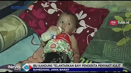 Bayi Penderita Sakit Kulit Ditelantarkan Ibu Kandung