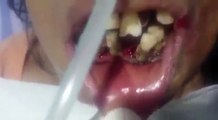 Bà cụ bị giòi làm tổ toàn bộ trong khoang miệng khiến răng rụng gần hết