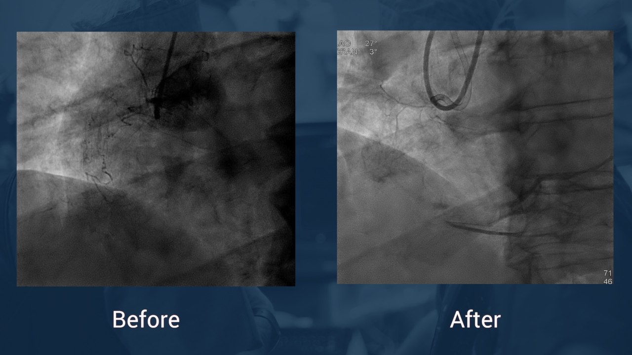 Tortuous and calcified ostial RCA CTO
