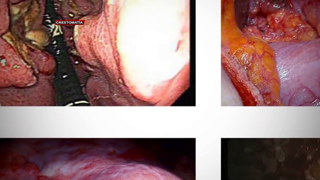 Se incrementan casos de cáncer en el mundo