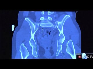 Pelvic Bone Ski Disaster, Will She Ski Again? | Head Above Water, Ep. 1