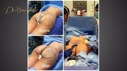What should I expect during my butt augmentation consultation?