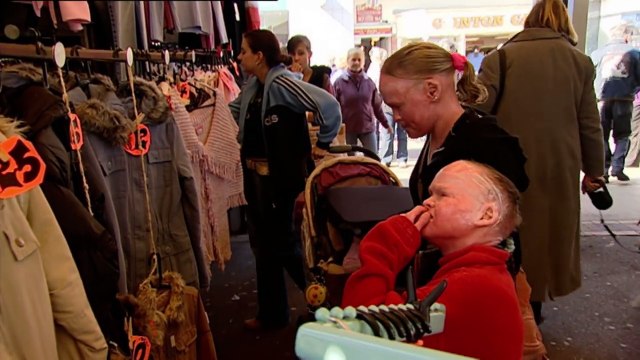 My Skin Could Kill Me (Medical Documentary) Real Stories