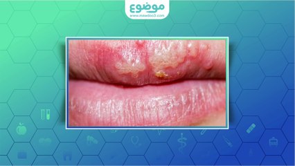 كيفية علاج تقرحات الفم