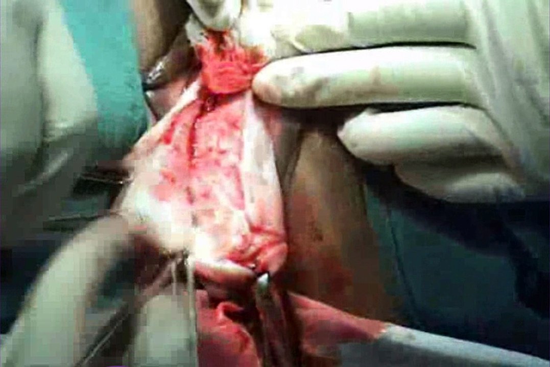 Cystocele Repair 1