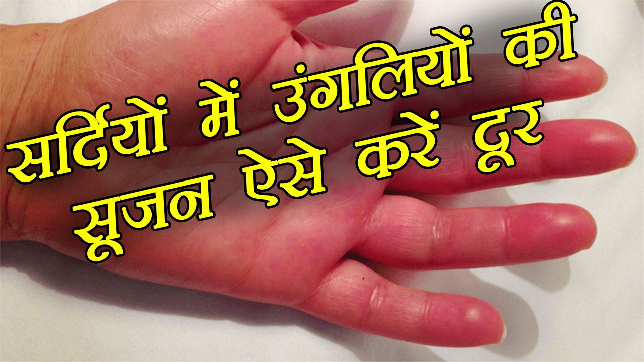 Finger Swelling in Winter | सर्दियों में उंगलियों की सूजन ऐसे करें दूर | Boldsky