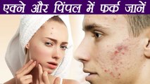 Acne and Pimples Differences & remedies | एक्ने और पिंपल्स में फर्क जानना ज़रूरी | Boldsky