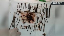 Iron Maiden? Doctors Remove Over 150 Metal Objects From Grandma's Stomach *GRAPHIC*