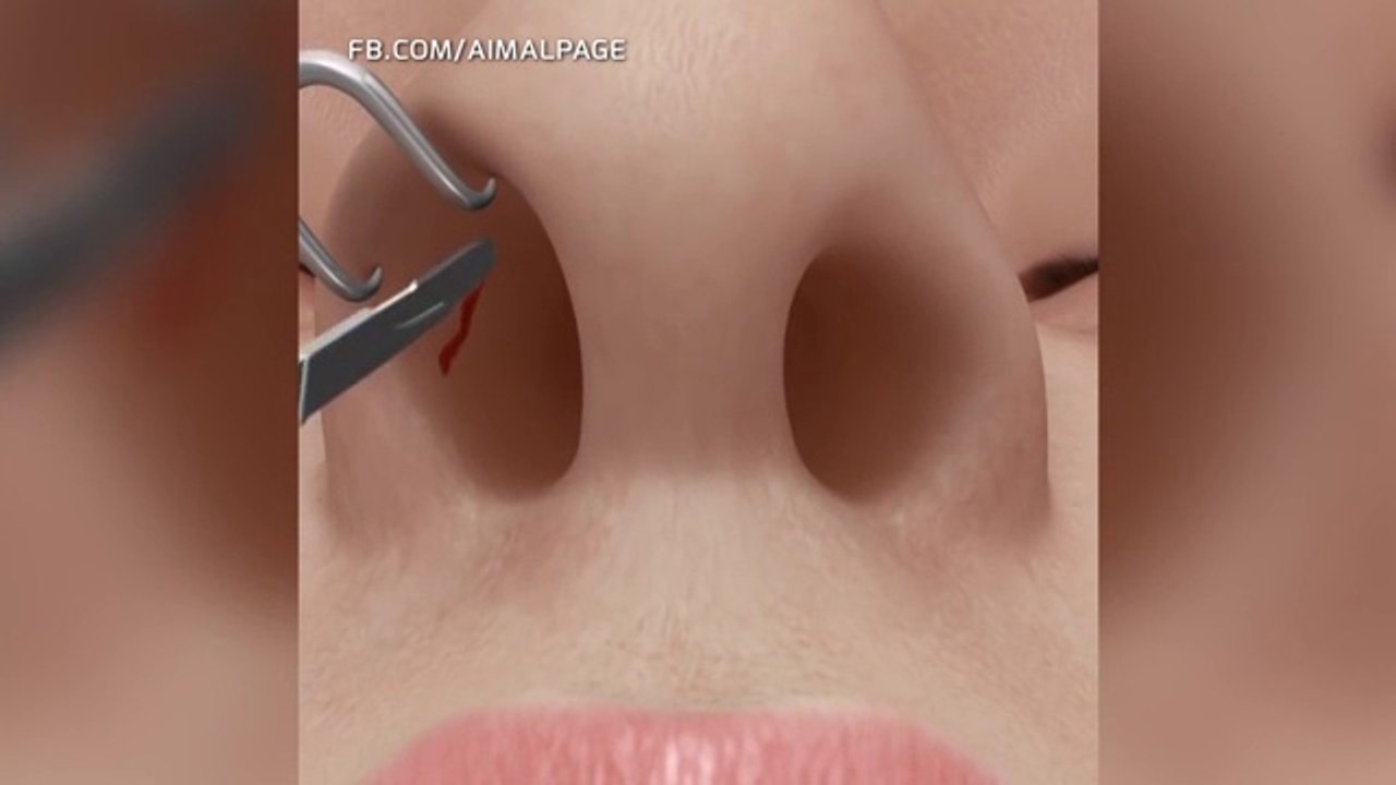 خضعت لعملية تجميل بأنفها.. شاهد النتيجة الكارثية