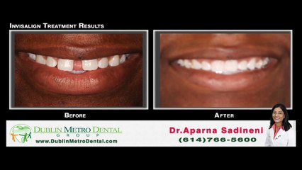 Kristina Invisalign Before & After Treatment Results - Testimonial