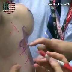 İlk kez yapay kol ile tanışan yaşlı adamın sevinci