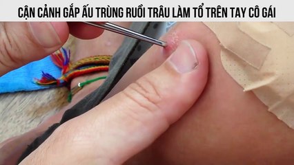 Cận cảnh gắp ấu trùng ruồi trâu làm tổ trên tay cô gái
