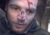 Syrian Journalist Wounded by Blast While Reporting on Strikes in East Ghouta
