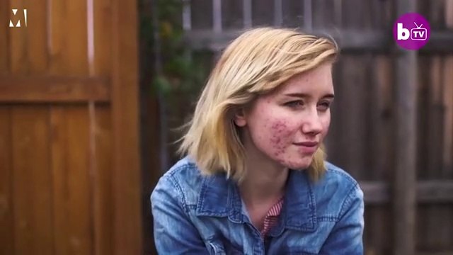 Cette fille touchée par l'acné nous montre son quotidien