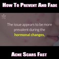 How To Prevent And Fade Acne Scars Fast