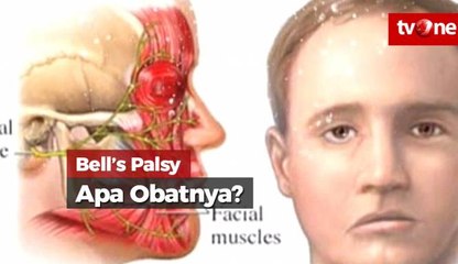 Bells Palsy, Apakah Ada Obatnya?